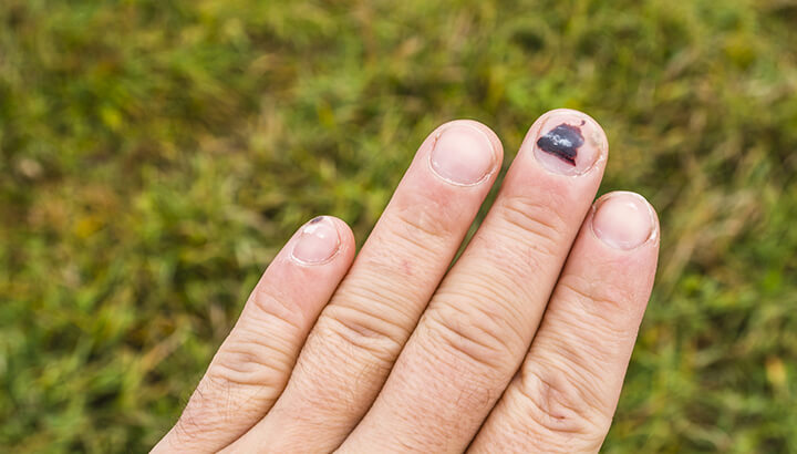 What Your Fingernail Lines Say About Your Health