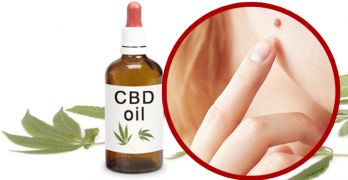 Can CBD oil get rid of moles