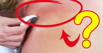 Gua Sha Scraping