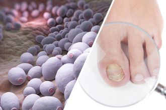 Signs that fungus is taking over the body