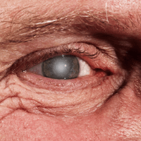 By Age 80 Half of All North Americans Will Deal with Cataracts By Age 80 Half of All North Americans Will Deal with Cataracts