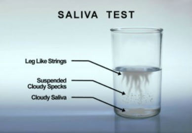 From yeast saliva infection Infectious Diseases