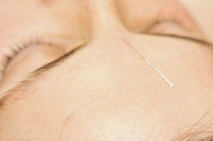 accupuncture treatment