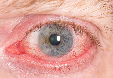 #1 Worst Oil That Promotes Blindness #1 Worst Oil That Promotes Blindness