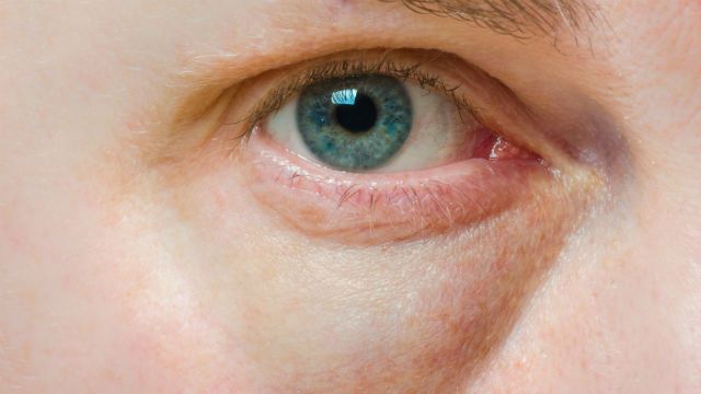 Puffy eye