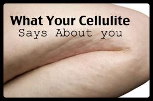 cellulite and health