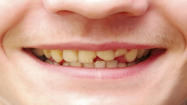 broken tooth