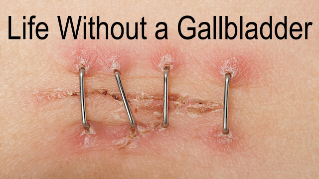 How to Live Well Without Your Gallbladder