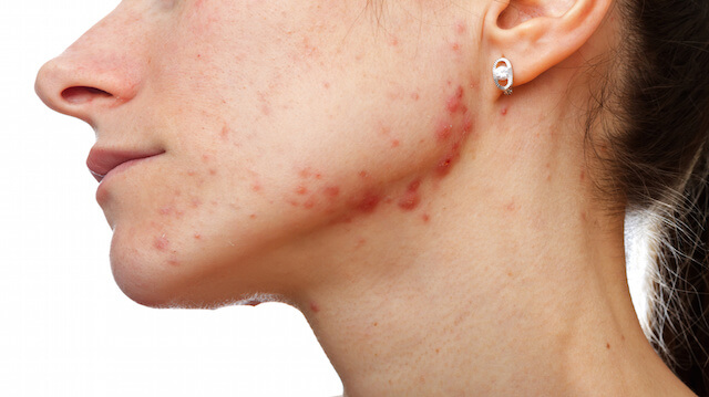 Rosacea On Neck | www.pixshark.com - Images Galleries With ...