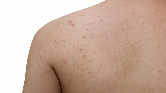 acne on a man back