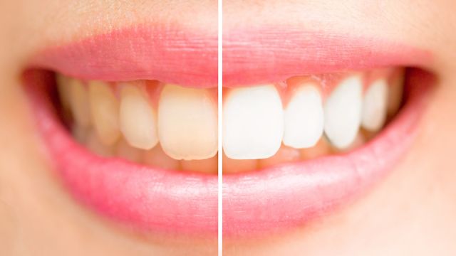 Close-up teeth female between before and after brush the teeth.