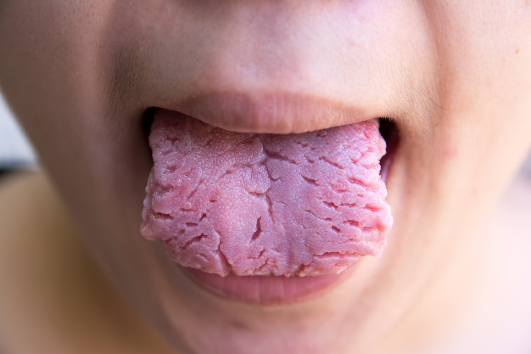 4. Tongue cracks 