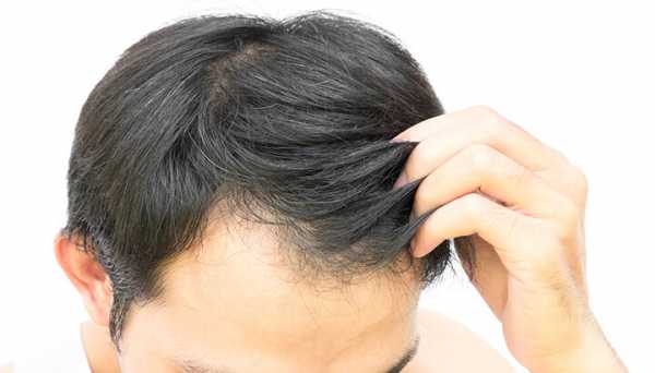 Fix Hair Loss With Black Seed Oil