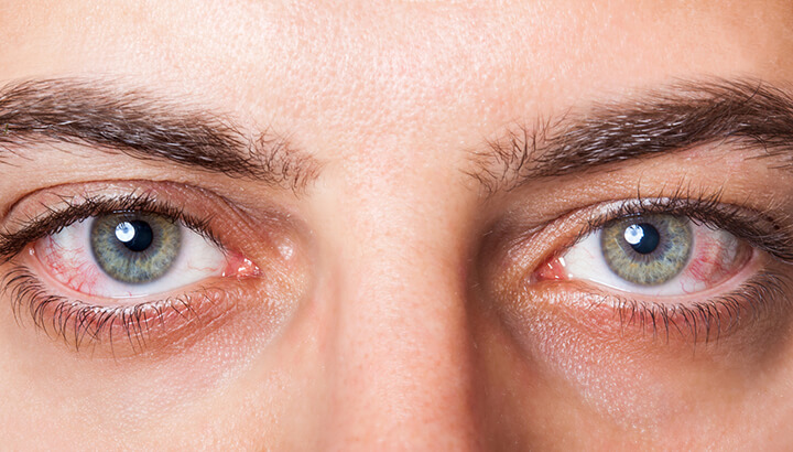 Red eyes are a sign of biological aging