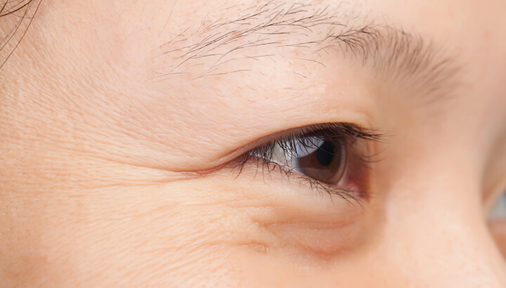 Wrinkles are an early sign of biological aging