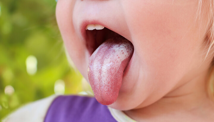 A white rash on the tongue may be a sign of thrush.