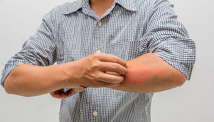 Activated charcoal can help relieve the itch from a bug bite.