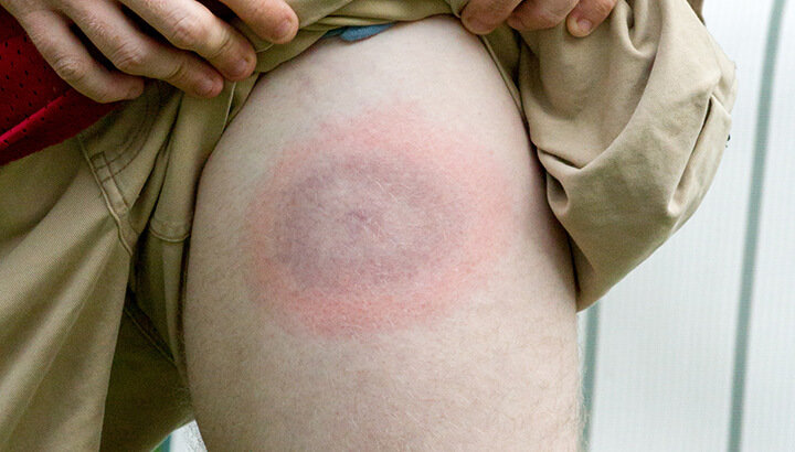 Bee sting therapy may help treat symptoms of Lyme disease.