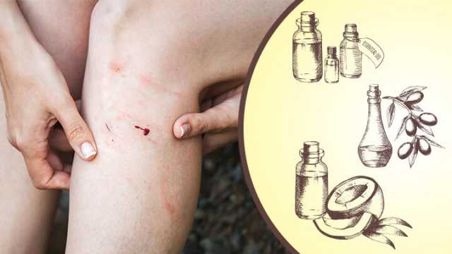 DIY Antifungal Cream