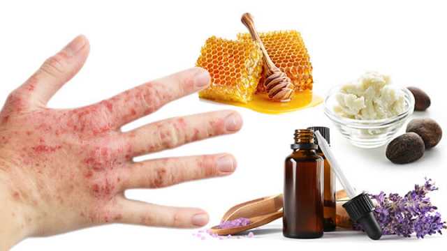 Eczema lotion