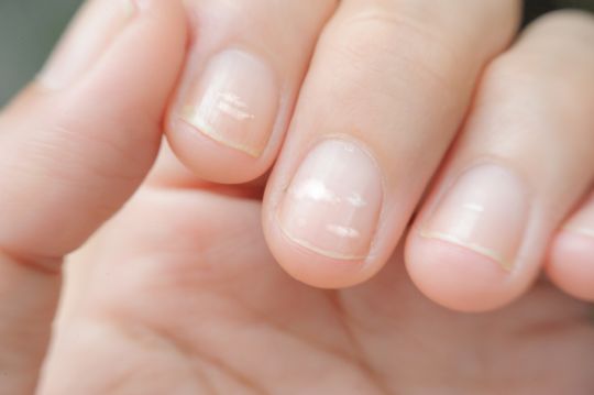 What Your Fingernail Lines Say About Your Health