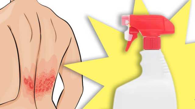 Shingles Spray