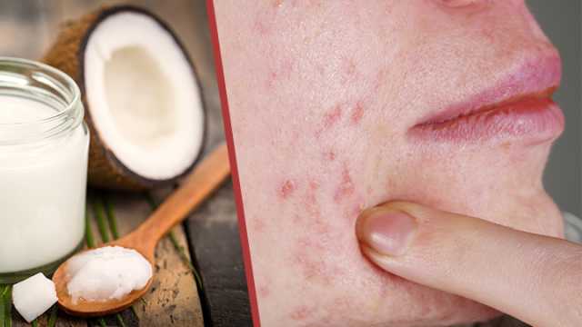 Zit-zapper salve