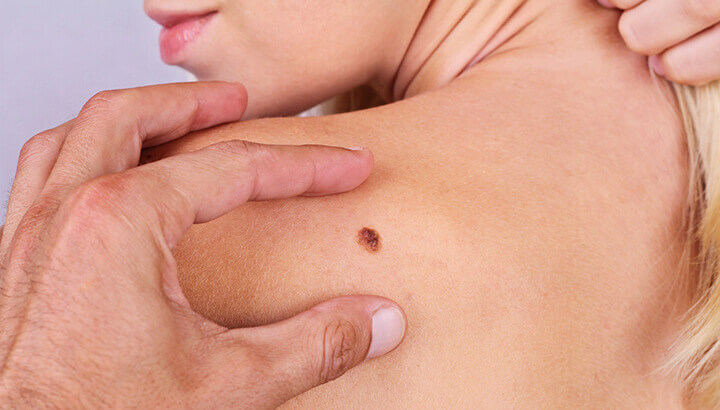 Melanoma has been on the rise, along with sunscreen use.