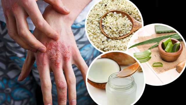 5 All Natural Remedies To Treat Eczema Without The Doctor