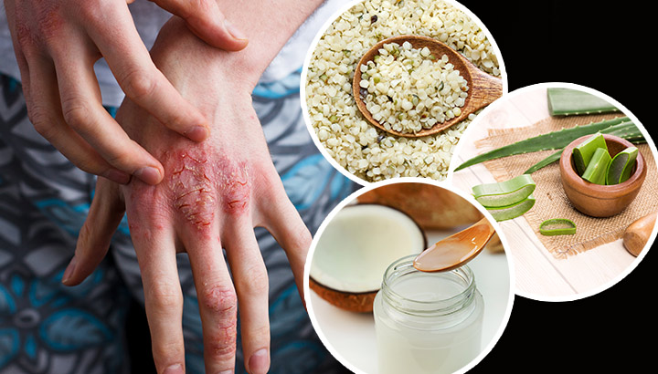 5 All Natural Remedies To Treat Eczema Without The Doctor
