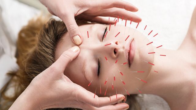 acupuncture