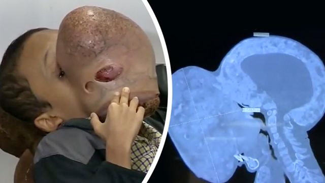 boydiesaftersurgerytoremove10poundtumorfromface_featured_960x540
