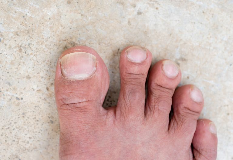 What Does Your Toes Tell About Your Health