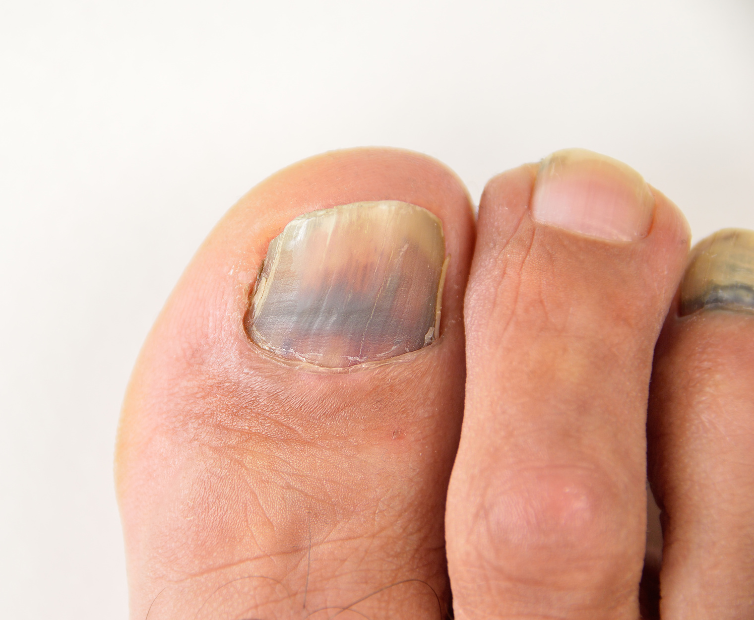 foot nail color for dark skin