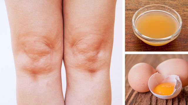 acvandeggyolksforswollenknees_featured_960x540