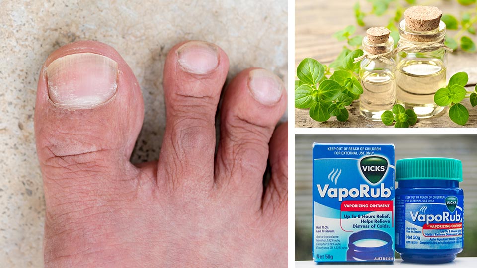 5 Natural Cures For Toenail Fungus You Can Find In Your Pantry 