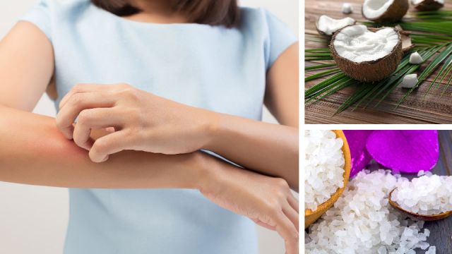 eczema5naturalremediesyouneedtotry_960x540