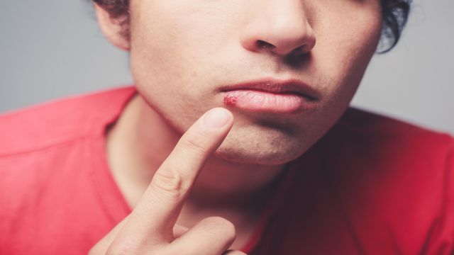 Young man with cold sore