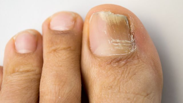 fungal nail infection
