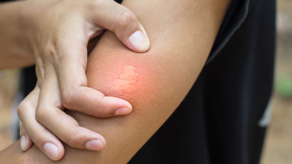 Closeup of bee sting stuck in human skin. The Alternative Daily