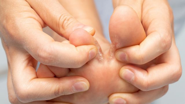 Closeup of barefoot of girl suffering with athlete's foot due to fungal infection