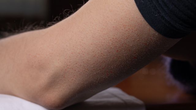 Female arm showing signs of keratosis pilaris in the form of reddish spots similar to the symptoms of acneiform rosacea